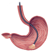 Верхняя эндоскопия (также известная как гастроскопия, EGD или эзофагогастродуоденоскопия) - это процедура, которая позволяет вашему хирургу исследовать слизистую оболочку пищевода (глотательной трубки), желудка и двенадцатиперстной кишки (первая часть тонкой кишки)