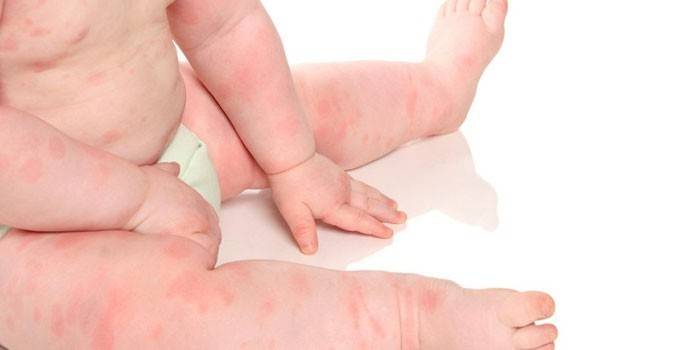 свербіж;   алергічні реакції;   кропив'янку;   ангіоневротичнийнабряк