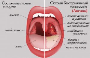 Червоне горло у дитини - частий симптом ангіни