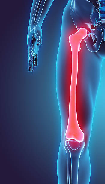 Чрезвертельний перелом - травма у верхній частині стегнової кістки, між підставою шийки стегна і подвертельной лінією