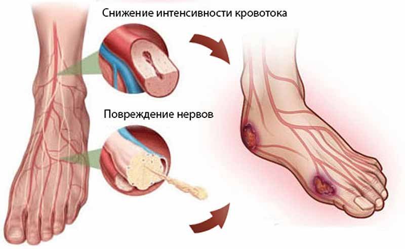 Проводять і інші лабораторні аналізи з метою уточнення діагнозу: проба на толерантність до глюкози, аналіз сечі на вміст глюкози і кетонових тіл, визначення   глікозильованого гемоглобіну   і С-пептиду