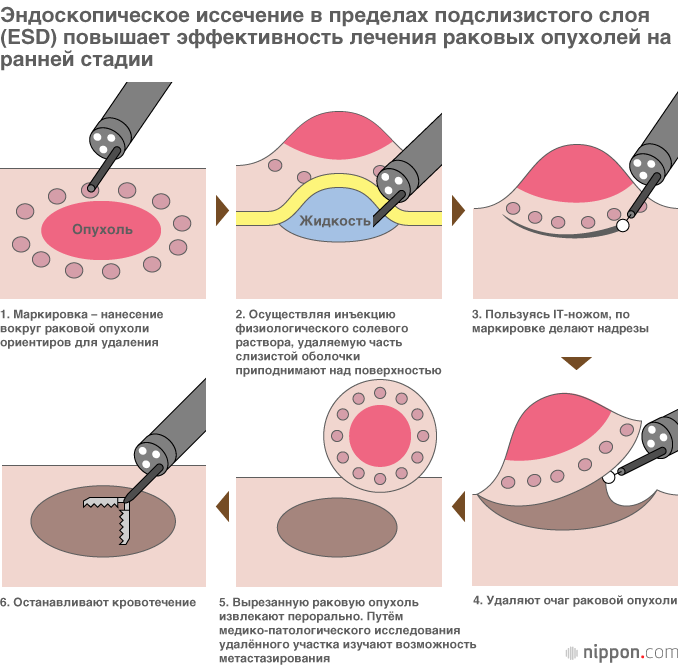 ESD (ендоскопічне висічення в межах підслизового шару) - новітній метод операцій, що виконується за допомогою ендоскопа