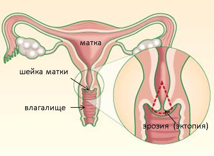 Менструальні виділення ощелачивают влагалищную середу, що сприяє розвитку мікробів