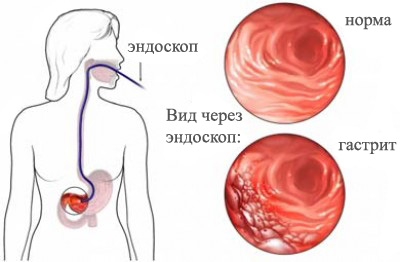 Запалення слизової порушує роботу шлунка, а значить, позначається на надходженні в організм речовин, необхідних для його життєдіяльності