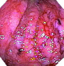 Хронічний гастрит - запалення слизової оболонки шлунка, що характеризується уповільненим патологічними процесами з періодичними загостреннями