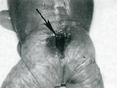 Вид задньої черепної ямки у плода після елімінації (відзначено стрілками)
