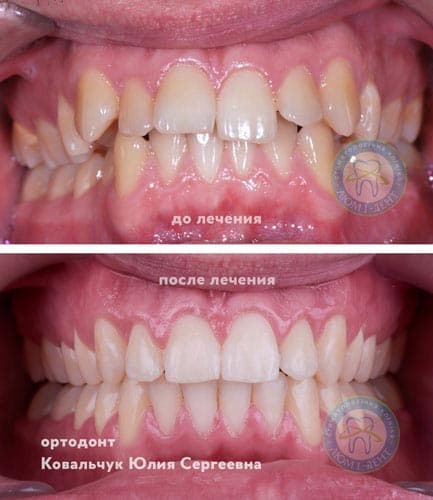Мережа клінік стоматології Люми-Дент пропонує недорого наступні види методик вирівнювання зубів у дітей (підлітків) і дорослих: