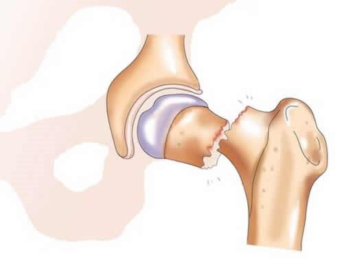 Шийка стегна - вузька і тому схильна до травмування частина стегнової кістки, для її перелому часом досить невеликого впливу