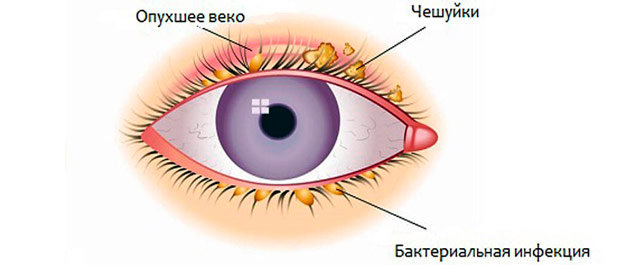 Що таке блефарит