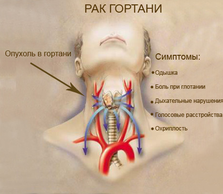 У хворого спостерігається   дисфония   , Дисфагія,   саливация   , Диспное, парестезії,   кровохаркання   , Неприємний запах з рота, загальна слабкість, виснаження