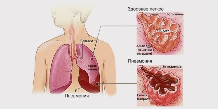 Причини смерті від пневмонії: