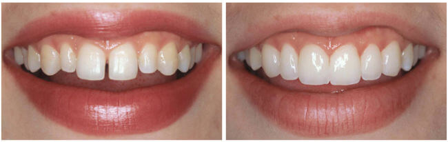 вініри   - тонкі керамічні пластинки-накладки на зуби - стають все більш популярним і ефективним рішенням найрізноманітніших естетичних проблем в стоматології