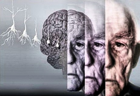 ЧИТАЙТЕ ТАКОЖ:   Загальні відомості про хвороби Альцгеймера