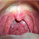 Щоб не було боляче з лівого боку горла, слід определітьпрічіну патології, яка може бути як бактеріального, так і вірусного характеру