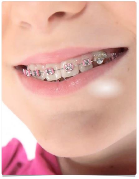 Брекет-система - це набір з безлічі пластинок, що приклеюються на зуби, що мають пази, в які вставляється металева дуга