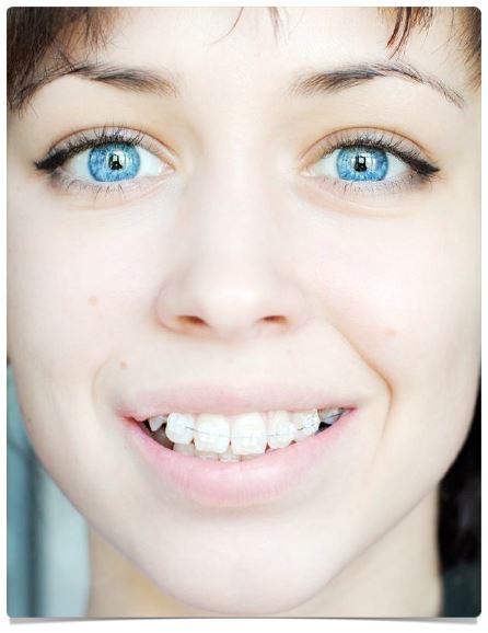 По розташуванню на зубах розрізняють вестибулярні і лінгвальні брекети