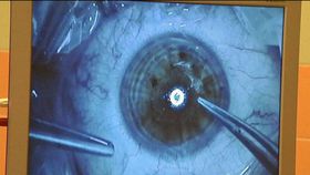 Ілюстративне фото: ЧТ24   - Нова методика відновлення рогівки полягає в використанні непошкоджених стовбурових клітин ока
