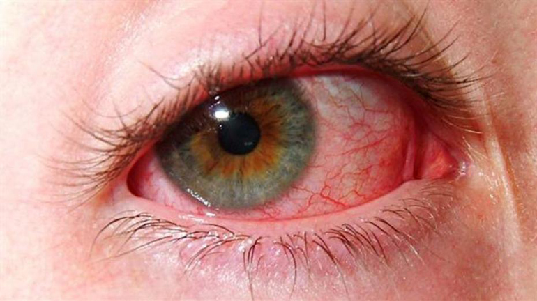 У цій статті розглянемо, чи допоможуть краплі для очей зняти запалення, набряклість і позбутися від дискомфортних відчуттів