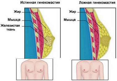 Гінекомастія - це патологічне збільшення грудей, викликане доброякісним розростанням жирової і залозистої тканини