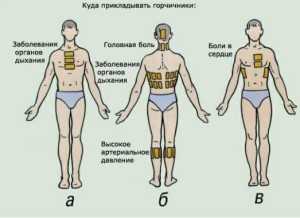 Як і банки, можна при бронхіті гірчичники використовувати вже на стадії одужання і без ознак інтоксикації і гіпертермії і з дозволу лікаря (особливо це стосується дітей)