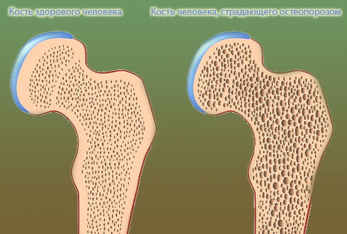 Гормональний збій призводить до розвитку у чоловіка   остеопорозу   - захворювання, що провокує зниження міцності кісток
