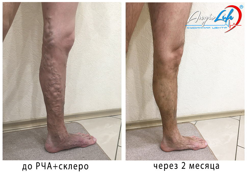 У судинному центрі   Angiolife   проводять найсучасніше, комплексне лікування варикозної хвороби, згідно з міжнародними рекомендаціями (European Venous Forum), основними принципами якого є: