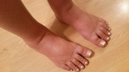 Зазвичай набряки виглядають як на фото