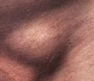 Для появи набутої патології необхідне поєднання двох умов: