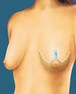Відвисла груди, опустилися тканини молочної залози, і деформувався її обсяг
