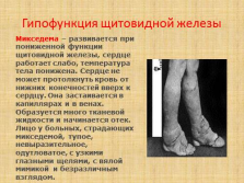 слайд №16   Гіпофункція щитовидної залози   Мікседема - розвивається при зниженій функції щитовидної залози, серце працює слабо, температура тіла знижена