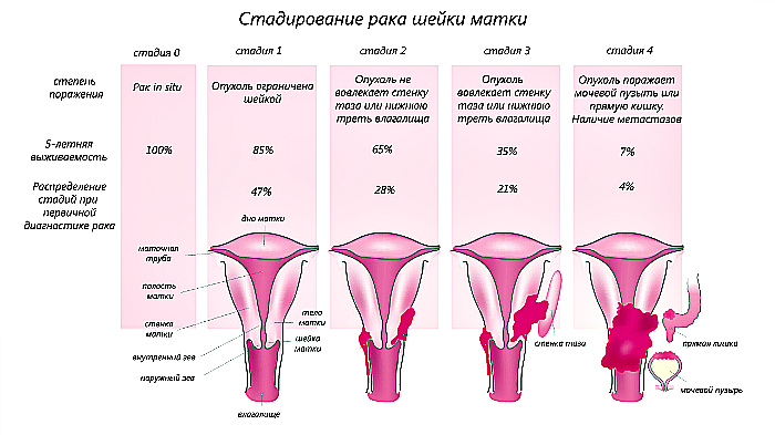 нульова (початкова) стадія, або як її ще називають - рак в собі (cancer in situ), коли є обмежену ділянку зміненого епітелію, який не виходить за слизовий шар;   перша стадія раку шийки матки - пухлина невеликих розмірів, що проростає в товщу шийки, але не виходить за її межі, без метастазів;   друга стадія раку шийки матки - пухлина займає більшу частину шийки і проростає в нижню частину матки, без метастазів;   третя стадія раку шийки матки - пухлина проростає шийку, матку, склепіння піхви, з метастазами в лімфовузлах;   четверта стадія раку шийки матки - пухлина виходить за межі матки, проростає в клітковину і органи тазу, з множинним ураженням лімфовузлів і віддаленими метастазами в органах, кістках