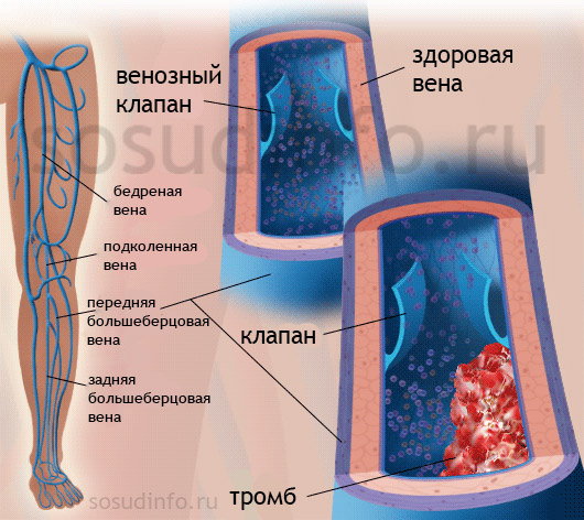 Тромбофлебіт глибоких вен нижніх кінцівок (його медичне позначення -   флеботромбоз   );   Тромбофлебіт підшкірних, поверхневих вен