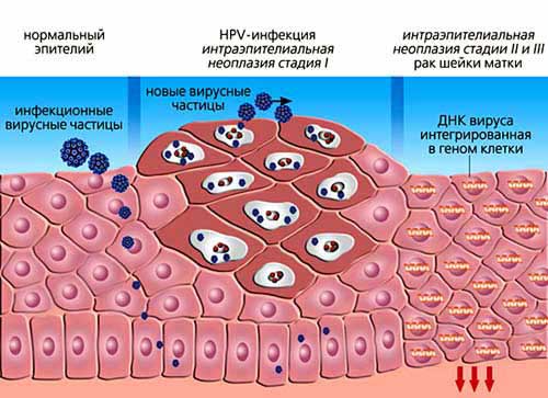 На фото зображено зміна структури тканин при прояві папіломавірусної інфекції