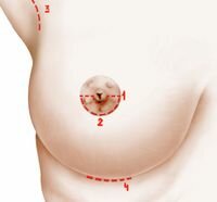 Методик проведення мастопексії розроблено безліч