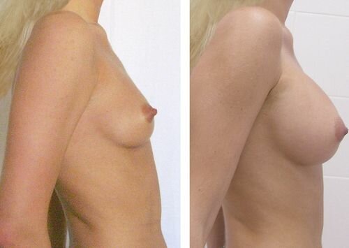 Фото до и после липофилинга грудей