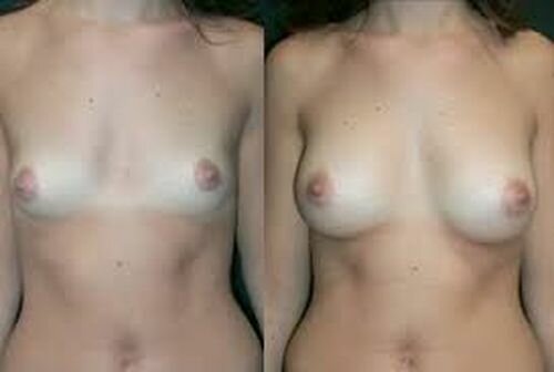 Фото до і після збільшення грудей гіалуроновою кислотою