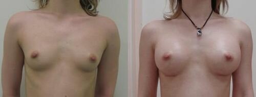 Фото до і після імплантації грудей