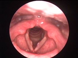 Гранулема голосових зв'язок проявляється у вигляді доброякісного утворення, що виникло внаслідок подразнення або травми голосових зв'язок, або травми слизової гортані