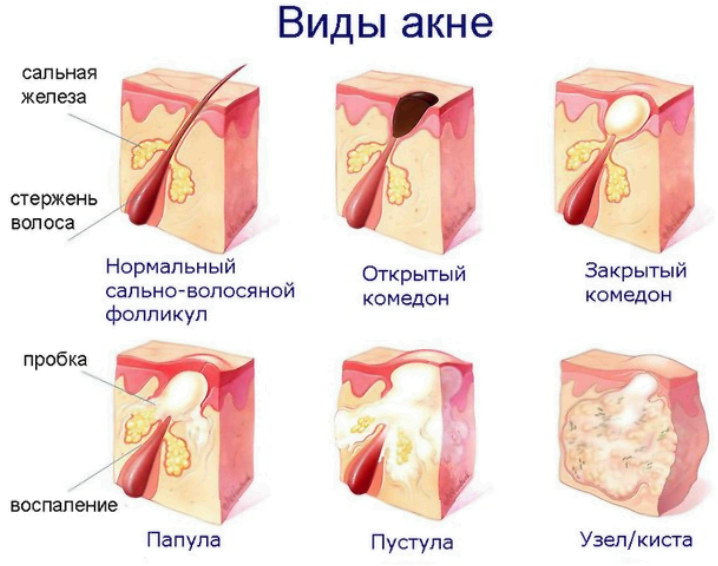 фолікулярні папули,   пустули,   вузли,   дренирующие синуси;