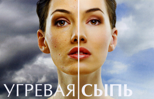 Анке - це загальна назва дефектів шкіри, що з'явилися в результаті закупорювання пір і запалення сальних залоз
