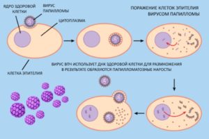 Зміст статті   Для чого приймається вірус надає на організм, як виявляється і як беруть аналіз на ВПЛ у чоловіків розповідається в даній статті