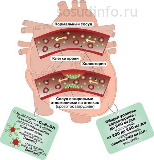 Від бляшок, що звужують просвіт судини, кровотік в цьому місці порушується ще більше
