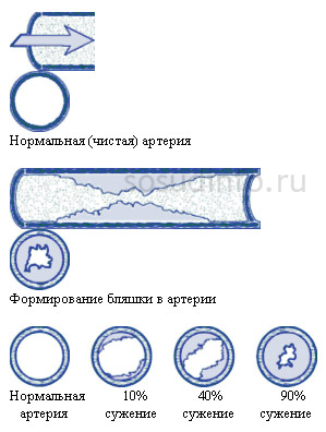 Можна собі уявити, як будуть реагувати судини серця на подібні зміни
