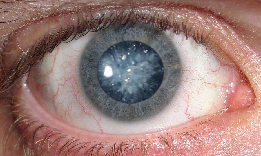 На відміну від старечої катаракти, ця патологія може зустрічатися навіть у людей молодше 30-40 років