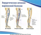 Слід пам'ятати, що операцію з видалення варикозних вен призначають тільки в тих випадках, коли розраховувати на успіх консервативних методик вже не доводиться