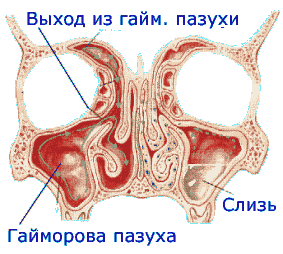 Отже, як уже зазначено, верхнечелюстная пазуха знаходиться біля носа, тому вона і називається - навколоносових (додаткових)