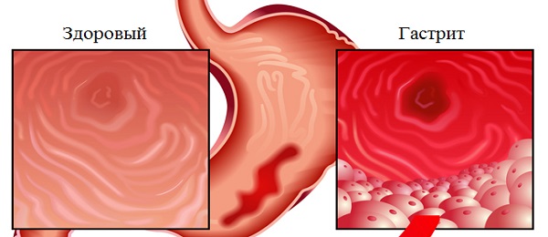 Це травне стан, викликаний пошкодженням і запаленням стінок шлунка і шлунково-кишкового тракту