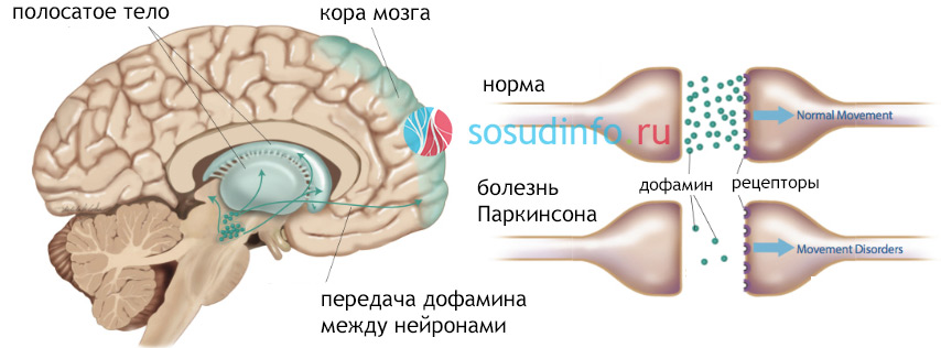 Вивчивши біохімічні процеси, що відбуваються в головному мозку осіб з характерною клінічною картиною, вчені прийшли до висновку, що виною синдрому паркінсонізму стає загибель нейронів, які відповідають за продукцію нейромедіатора, званого дофамином