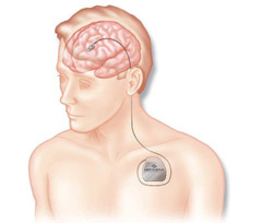 До прориву в боротьбі з паркінсонізмом призвело впровадження в практику радіохірургічних методів лікування