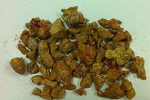 гостра, часто нестерпний біль у ділянці нирок з правого або лівого боку, яка може «віддавати» в пах, статеві органи або ноги;   нудота блювота;   домішки крові в сечі - наслідок пошкодження гострим краєм конкременту слизової оболонки, що вистилає сечовивідні шляхи зсередини;   чим ближче камінь до сечового міхура, тим відчутніше стають печіння і позиви на відвідування туалету;   про те, що камені вийшли з нирок, може свідчити також підвищення температури, яке супроводжується сильним ознобом